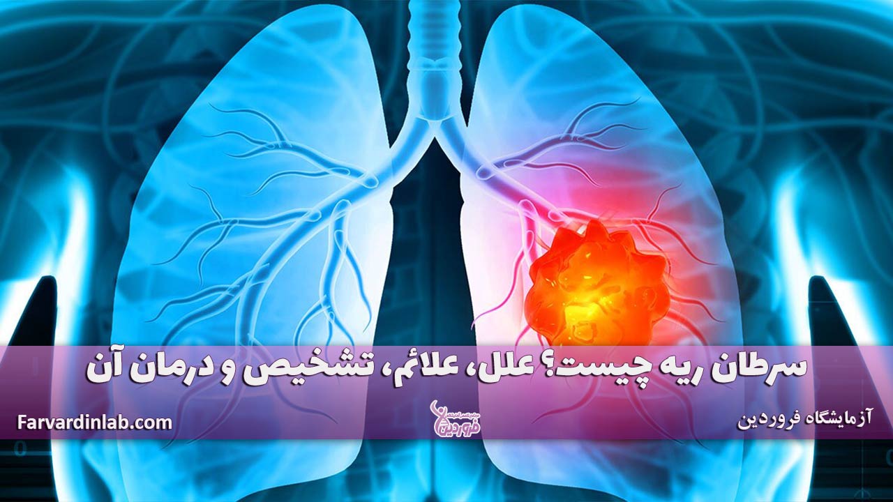 سرطان ریه چیست؟