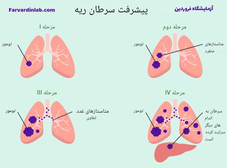علائم مرگ در سرطان ریه