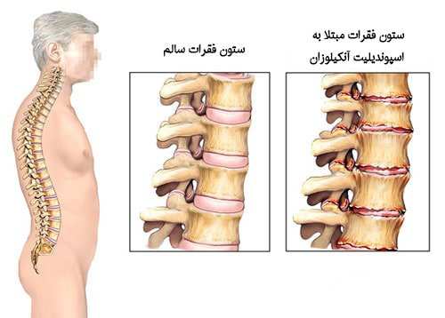 اسپوندیلیت