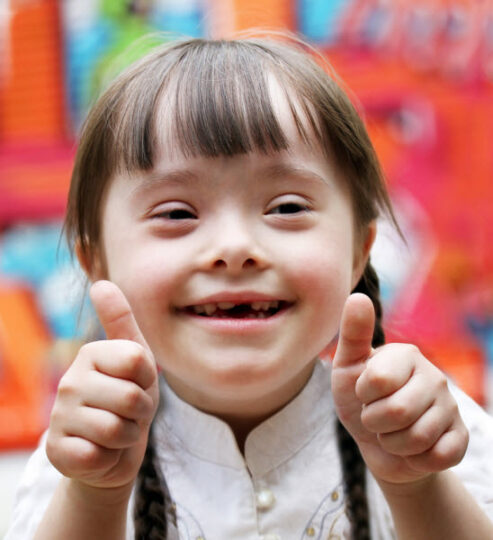 آزمایش کاریوتایپ - سندرم داون