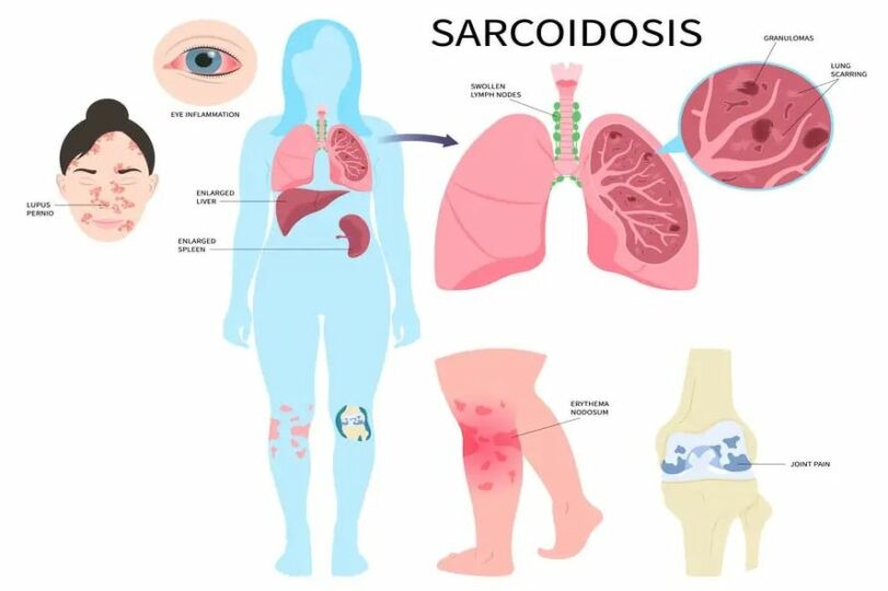 سارکوئیدوز بیماری شبه سل - آزمایشگاه فروردین