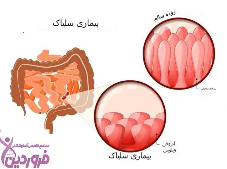 بیماری سلیاک - آزمایشگاه فروردین