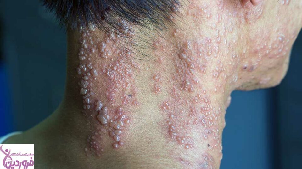 زونا - آزمایشگاه فروردین