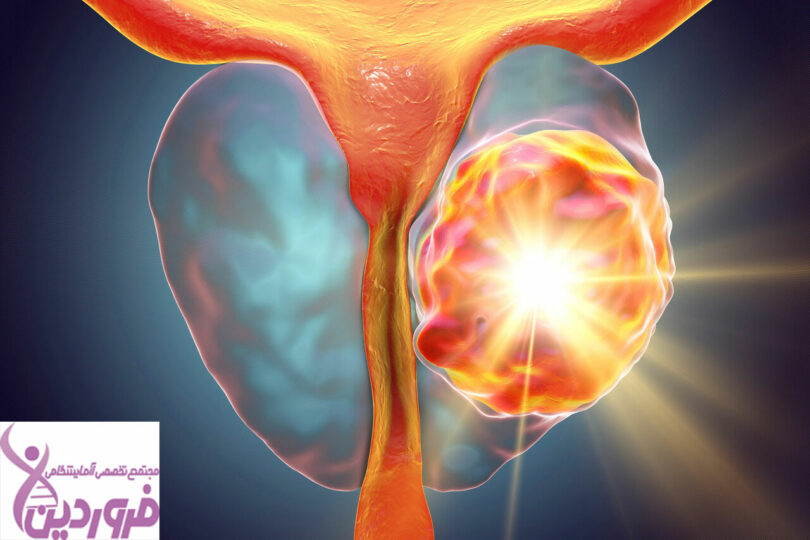 سرطان پروستات