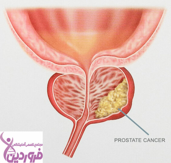 سرطان پروستات - آزمایشگاه فروردین