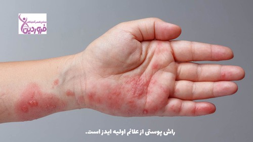 علائم اصلی و مهم ایدز ، عکس بیماری ایدز