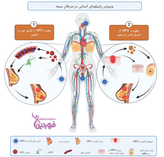 ارتباط بین سرطان پستان و ویروس hpv