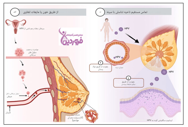 ارتباط بین سرطان پستان و ویروس hpv