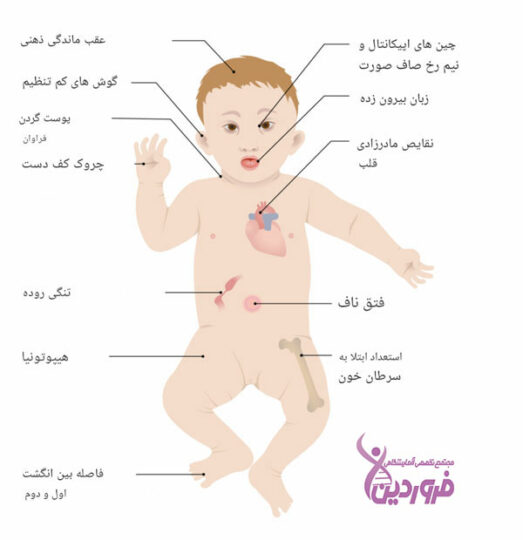 تشخیص سندروم داون در بارداری