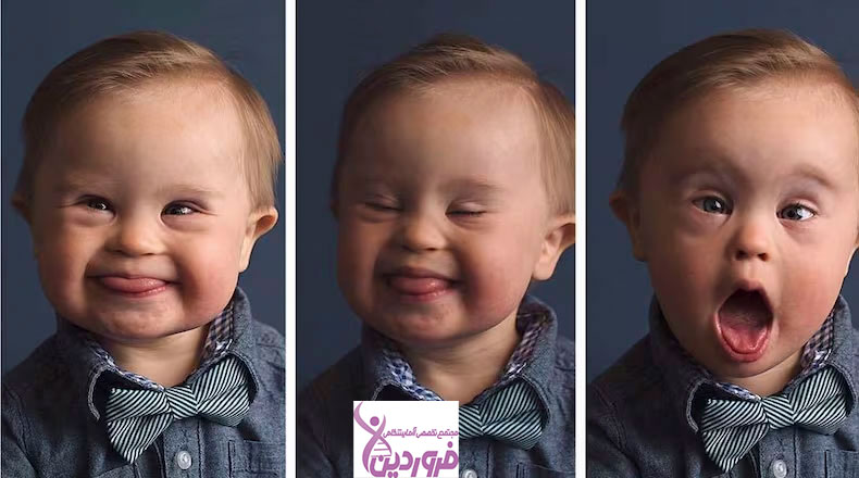 تشخیص سندروم داون در بارداری