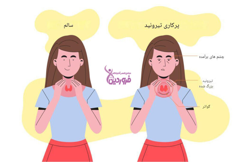 علائم کم کاری تیروئید - آزمایشگاه فروردین