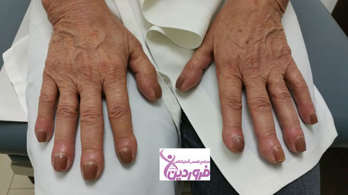 چخماقی شدن ناخنها