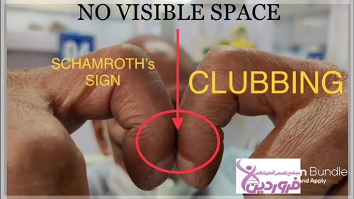 تست سرطان ریه در منزل