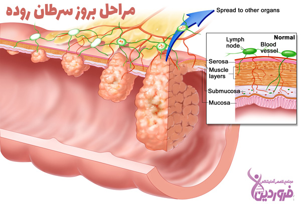 مراحل بروز سرطان روده