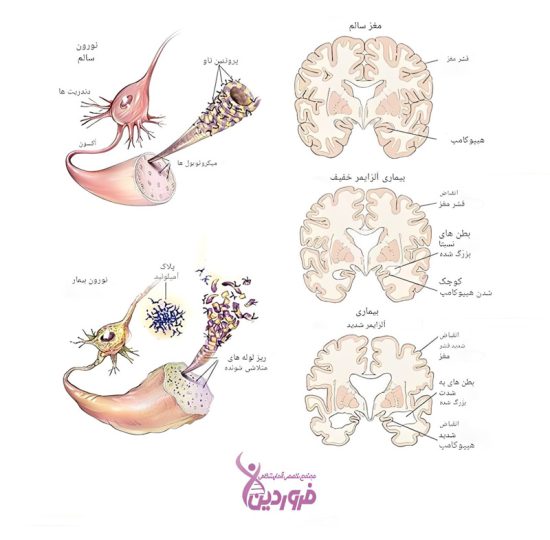 روشهای نوین ژنتیکی و شیمیایی برای تشخیص آلزایمر