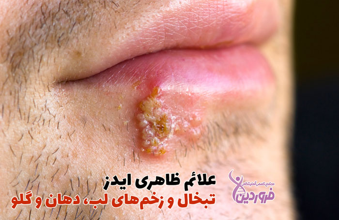 تبخال، زخمهای دهان و لب از نشانه های ایدز است
