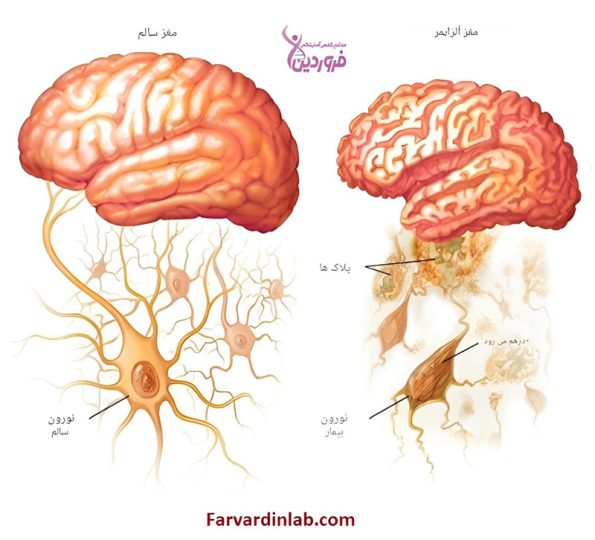 روشهای ژنتیکی برای تشخیص آلزایمر