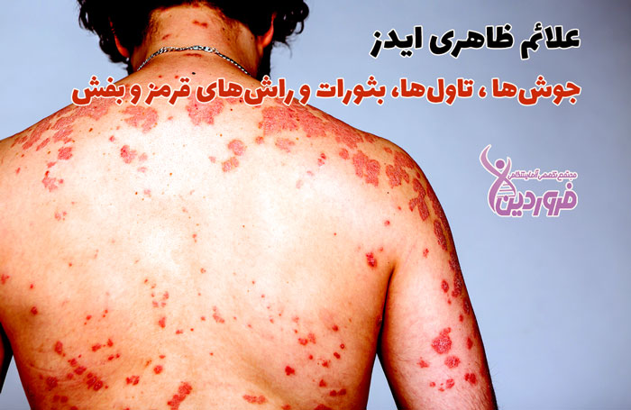 علائم ظاهری و پوستی و ایدز