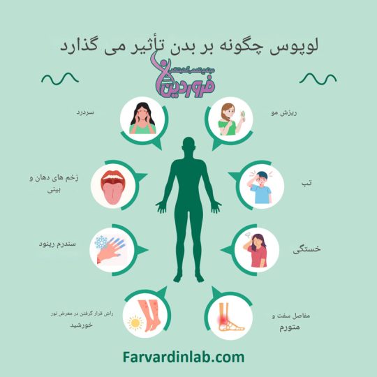 علائم لوپوس