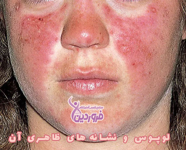 عوارض پوستی لوپوس