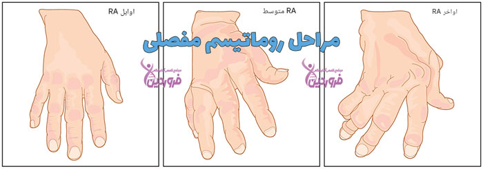 مراحل آرتریت روماتوئید