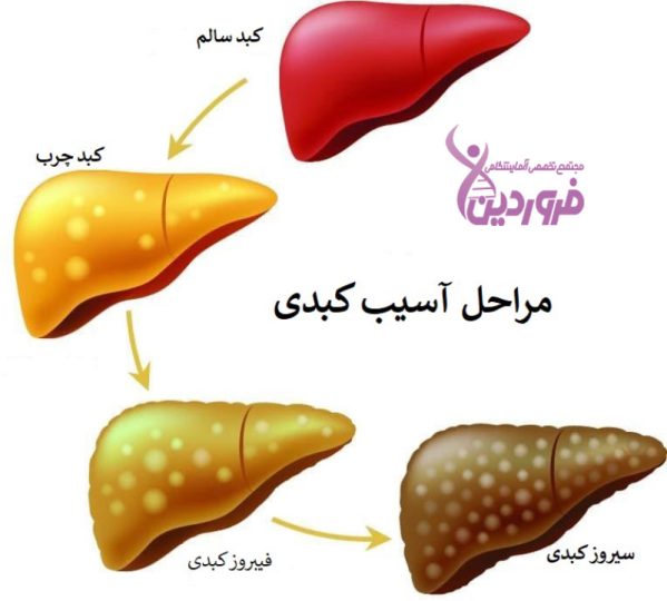 مراحل بیماریهای کبدی