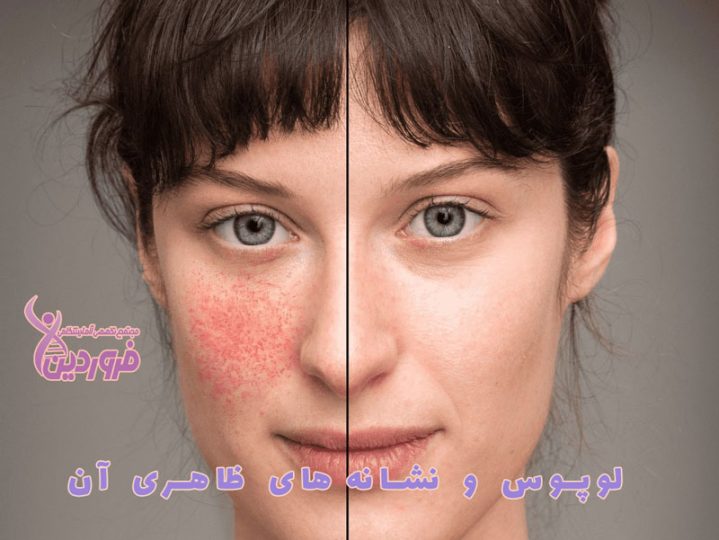 راش پروانه ای روی صورت