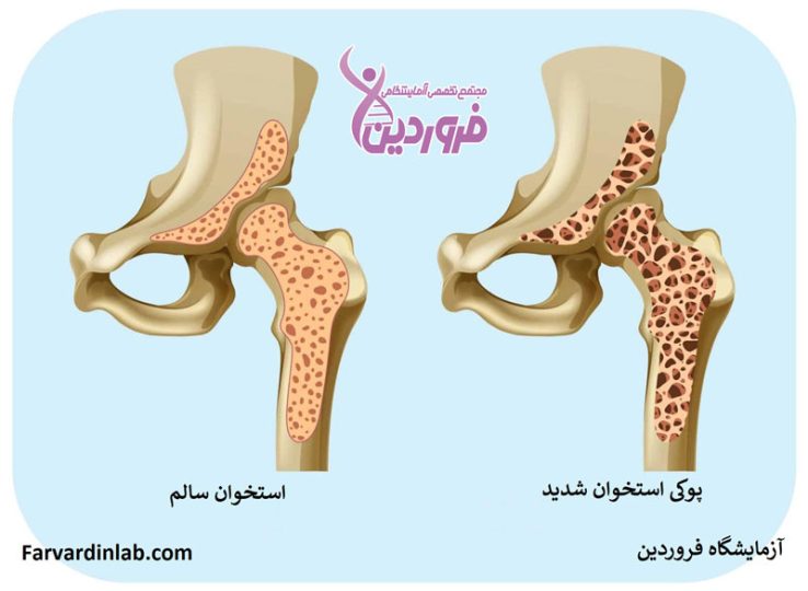 پوکی استخوان