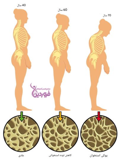 روند پوکی استخوان در زنان