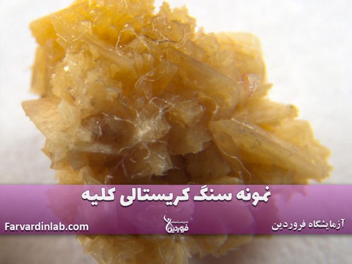 سنگ کریستالی در کلیهها