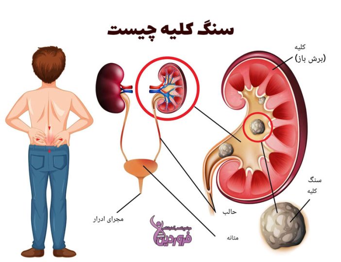 سنگ شکن برای کلیه