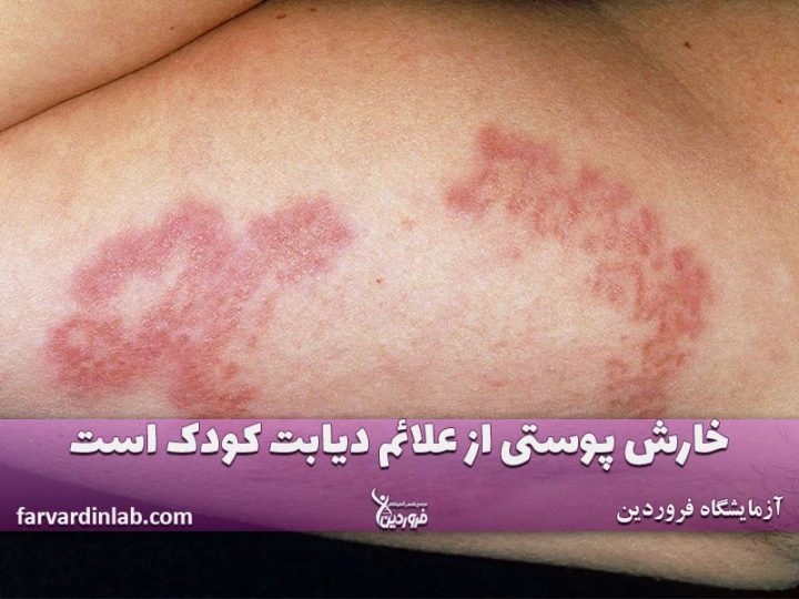 پوست دیابتی