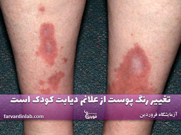 تغییر رنگ پوست و بیماری قند