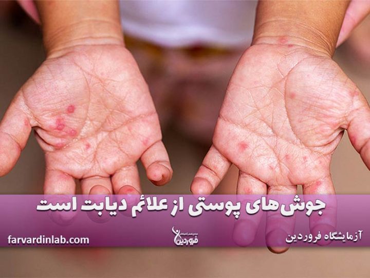 علائم پوستی دیابت در کودکان