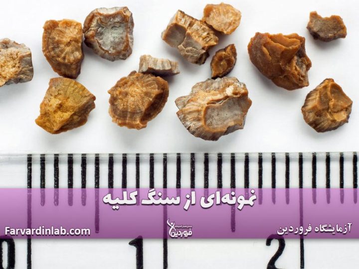 درمان کلیه سنگ ساز