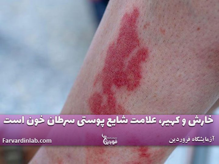 نشانه ظاهری بیماری سرطانی