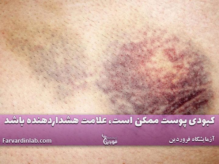 عکس سرطان خون