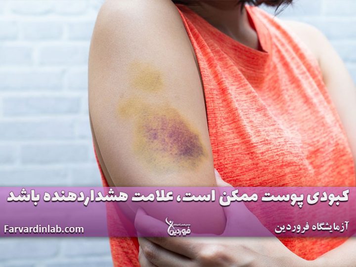 عکس کبودی سرطان خون