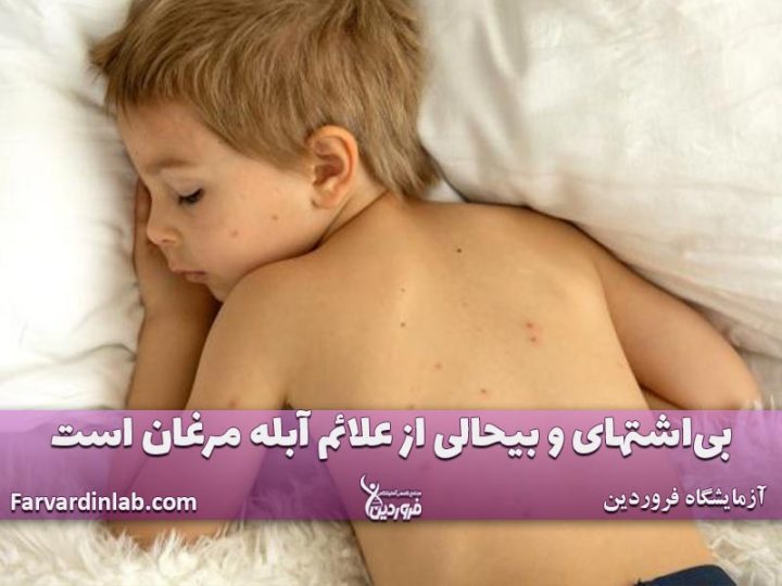 آبله مرغان در کودک