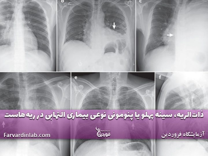 ذات‌الریه چیست؟