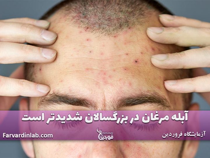 آبله مرغون در بزرگسالان