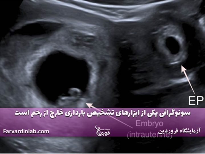 تشخیص حاملگی خارج از رحم با آزمایش