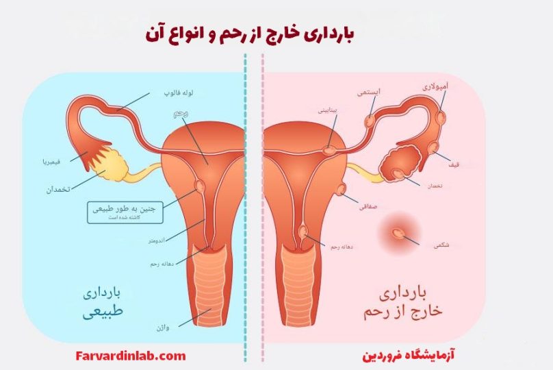 علائم بارداری خارج از رحم با بیبی چک
