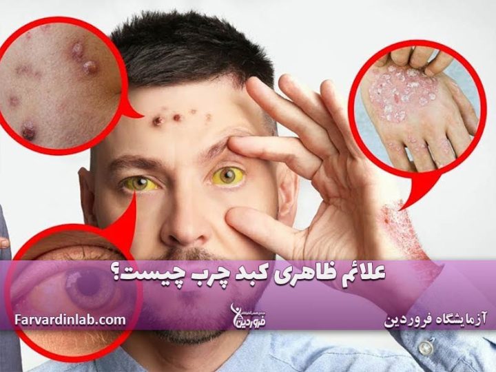 علائم کبد چرب در چهره