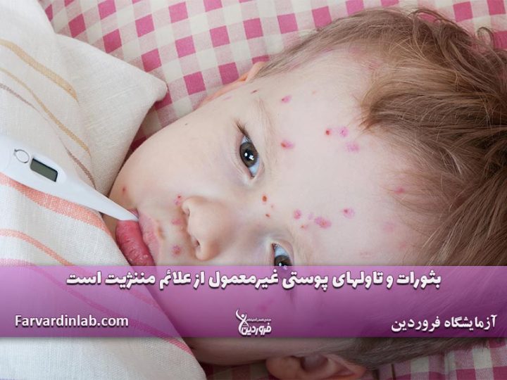علائم اولیه بیماری مننژیت در کودکان