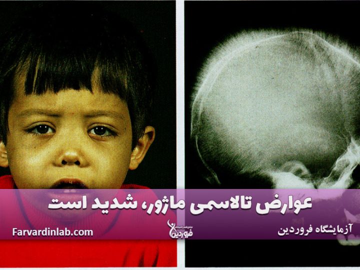 تالاسمی ماژور چیست؟