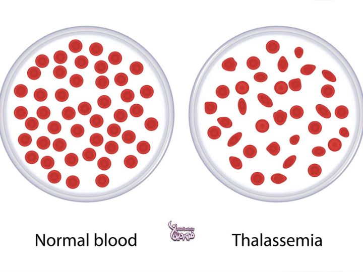 تالاسمی چیست