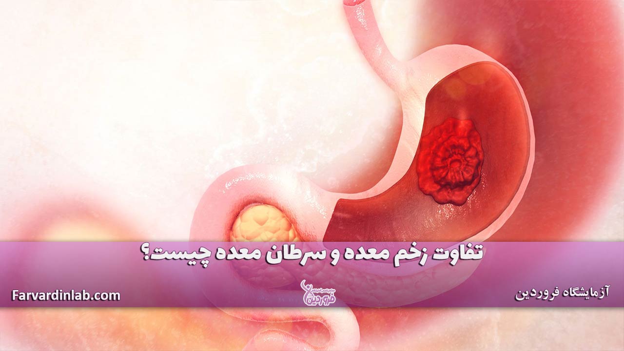 زخم معده و سرطان معده چه فرقی دارند