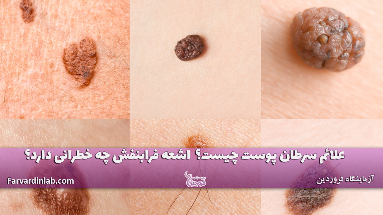 علائم سرطان پوست