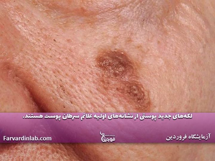 نشانه های اولیه سرطان پوست